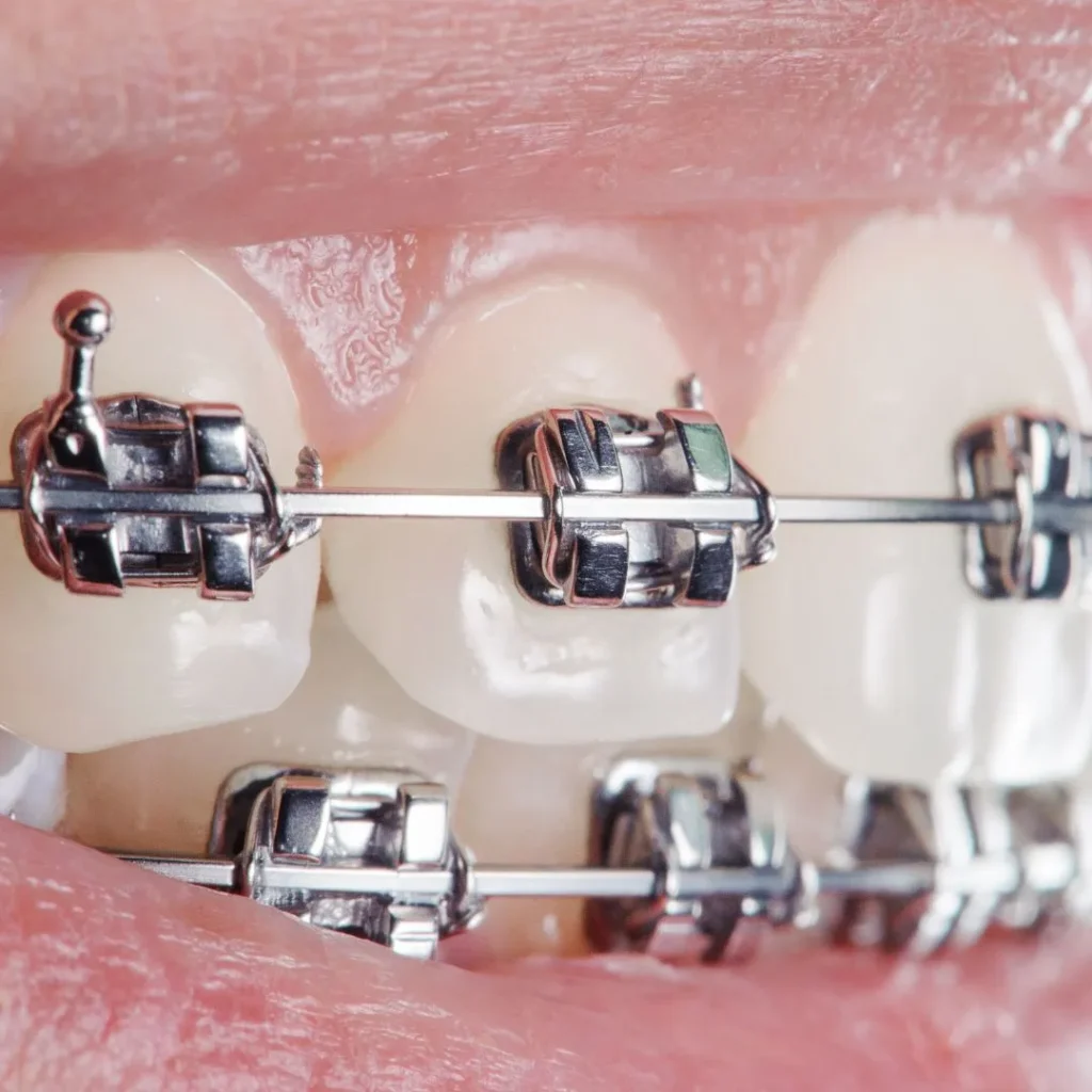 fixed braces in Kirkby Lonsdale in Cumbria